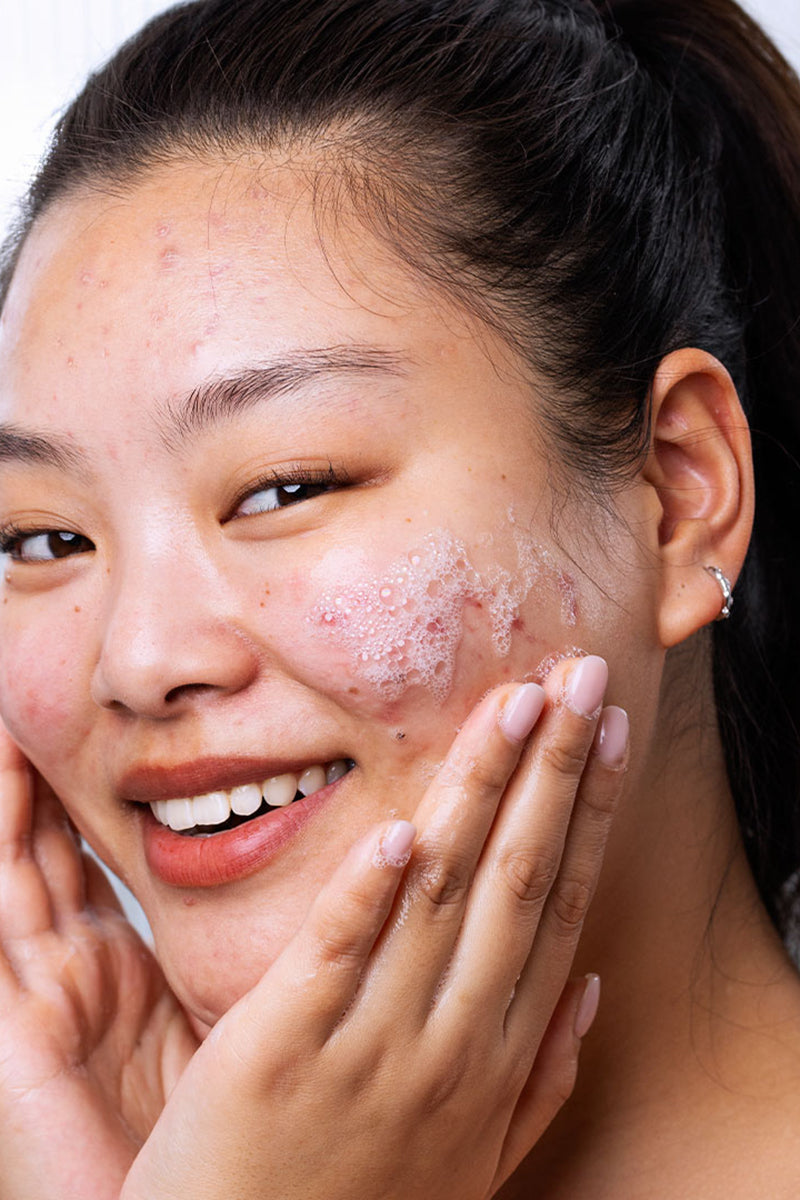 Piel con tendencia al acné hormonal: brotes inesperados, soluciones reales