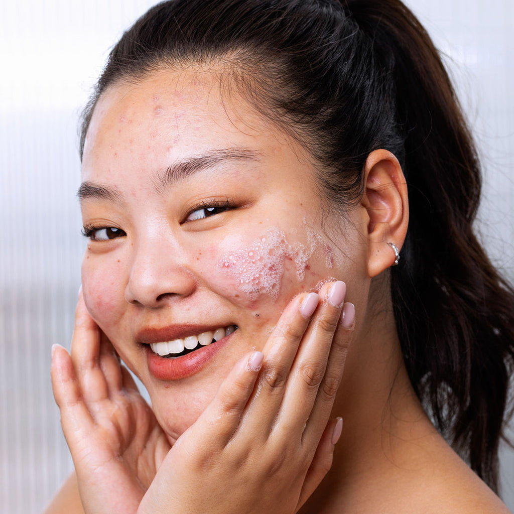 Una mujer asiatica con tendencia acneica en el rostro e imperfecciones aplicando producto en las mejillas con ambas manos generando espuma del SEBIACLEAR Gel Moussanten el rostro, con fondo blanco