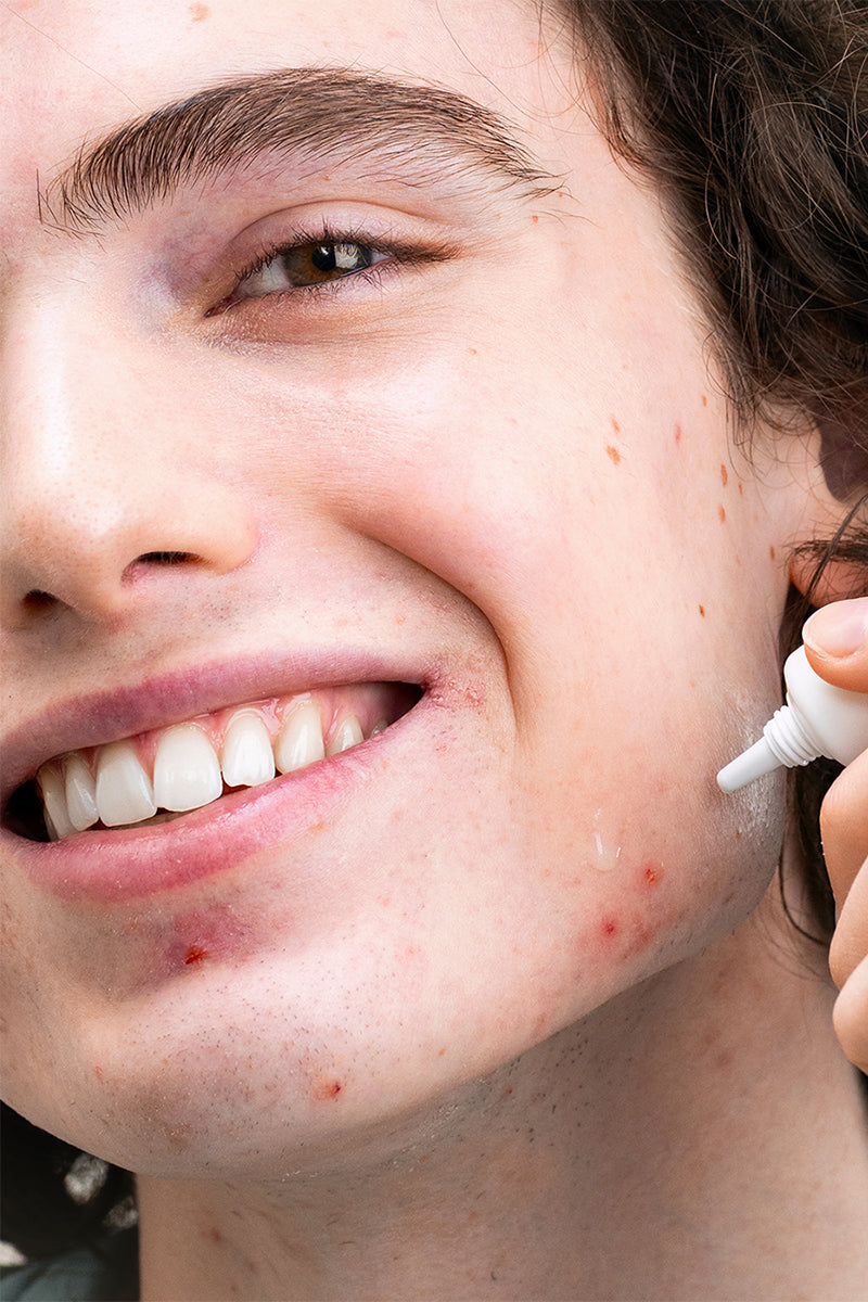 Brillo, puntos negros e imperfecciones: ¿qué señales da tu piel?