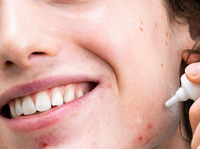 Brillo, puntos negros e imperfecciones: ¿qué señales da tu piel?
