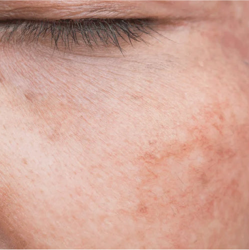 Tipos de ojeras: cómo saber cuál tienes y qué tratamiento elegir