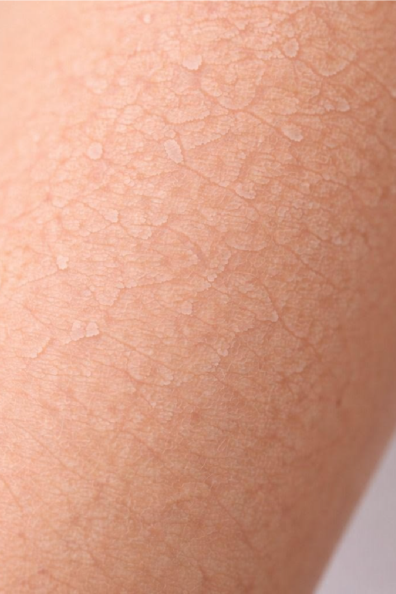 ¿Piel seca o tendencia atópica? Cómo identificar tu tipo de piel 🔎