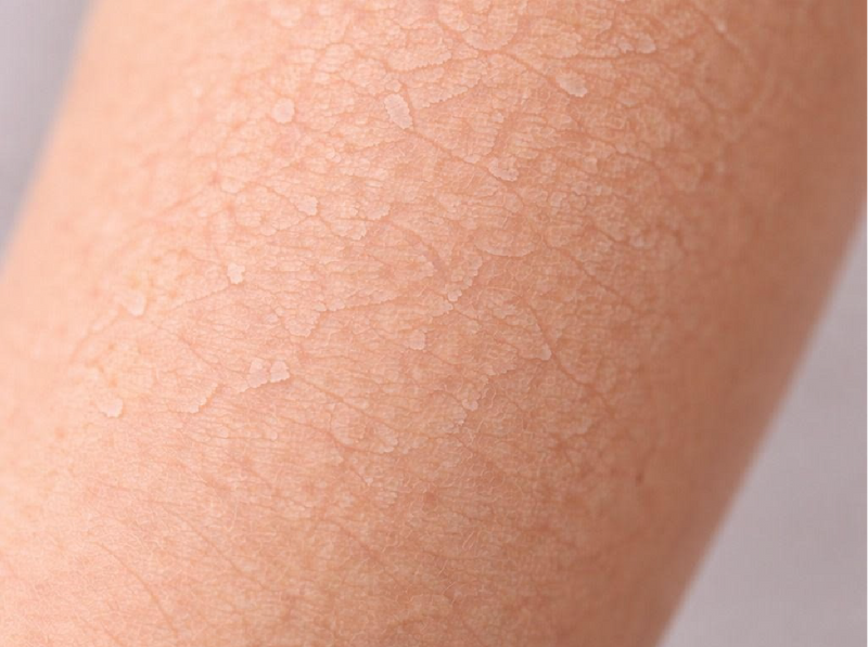 ¿Piel seca o tendencia atópica? Cómo identificar tu tipo de piel 🔎